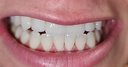 Избелване на зъби с най-новата Flash Lightening lamp + бонус почистване на зъбен камък със 73% отстъпка