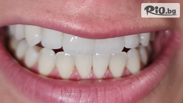Избелване на зъби с най-новата Flash Lightening lamp + Бонус почистване на зъбен камък с 55% отстъпка, от Afrodita Aesthethic and Dental Care