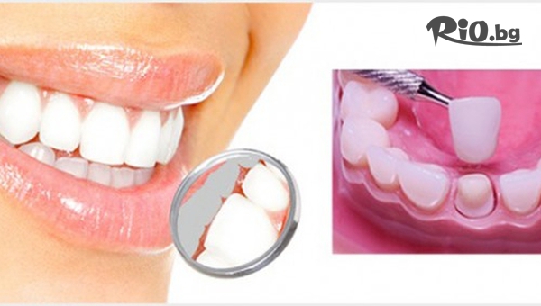 Поставяне на металокерамика, изграждане на зъб с 56% отстъпка, от Стоматологичен кабинет Д-р Лозеви
