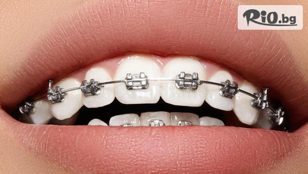 Поставяне на метални брекети на една челюст или две челюсти + Безплатни прегледи до края на лечението, от Стоматологичен кабинет Д-р Лозеви