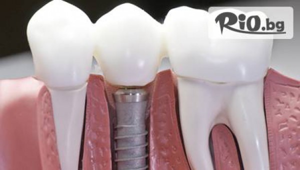550 лв за зъбен имплант Alpha – Bio Tech от  Д-р Александров, практикуващ дентален имплантолог в Лондон