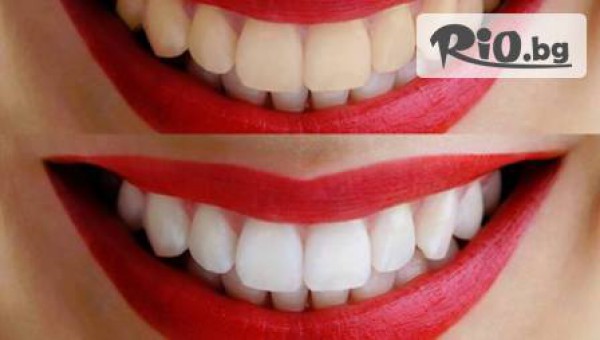 Избелване на зъбите с професионалната система POLA OFFICE PLUS + почистване на зъбен камък и полиране с 62% отстъпка за 114.90лв, от Д-р Караджова