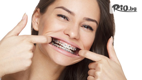 Поставяне на метални брекети на една челюст или две челюсти + Безплатни прегледи до края на лечението с 80% отстъпка, от Стоматологичен кабинет Д-р Лозеви