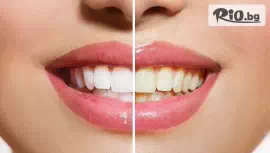 Професионално избелване на зъби #1