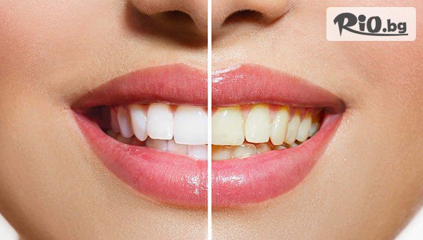 Професионално избелване на зъби със 70% отстъпка, предоставено от КАЛИАТЕА ДЕНТ ООД