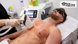 Лазерна епилация за мъже #1
